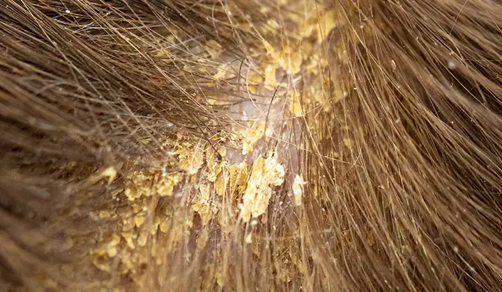 Typische symptomen van seborroïsch eczeem zijn schilfers, jeuk en klonters van dode hoofdhuidcellen.