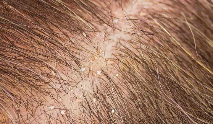 Il y a aussi des pellicules sur un cuir chevelu normal.