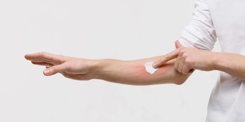 Gebruik een verkoelende crème