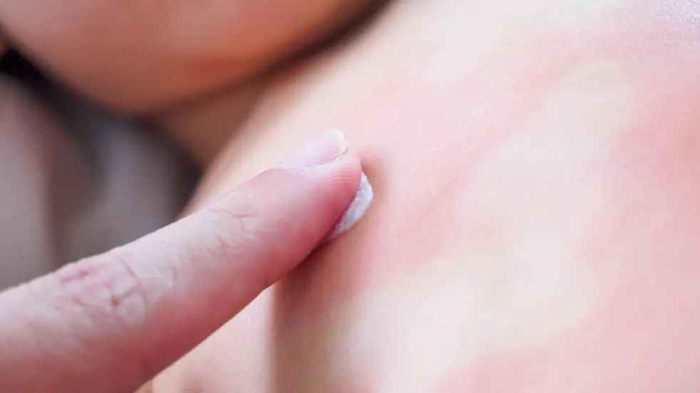 Découvrez ici comment traiter l'eczéma.