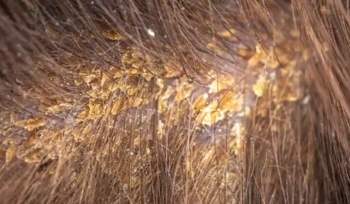 On parle d'eczéma séborrhéique lorsque les cellules Malassezia sont présentes à 83 %.