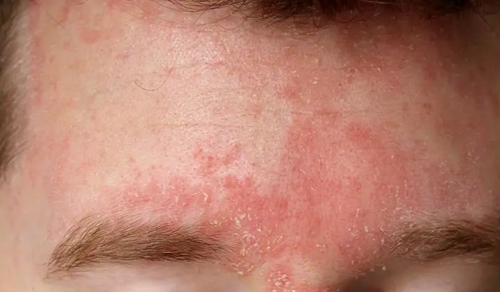 En utilisant un shampoing qui contient du kétoconazole, vous pouvez également vous débarrasser de l'eczéma séborrhéique.