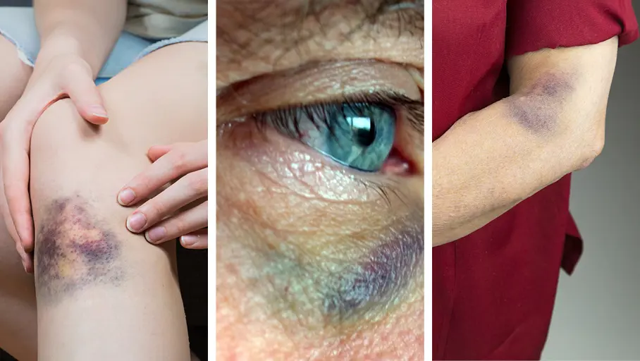 La plupart des contusions, épanchements et hématomes disparaissent spontanément en quelques jours, mais un traitement topique peut favoriser la guérison.