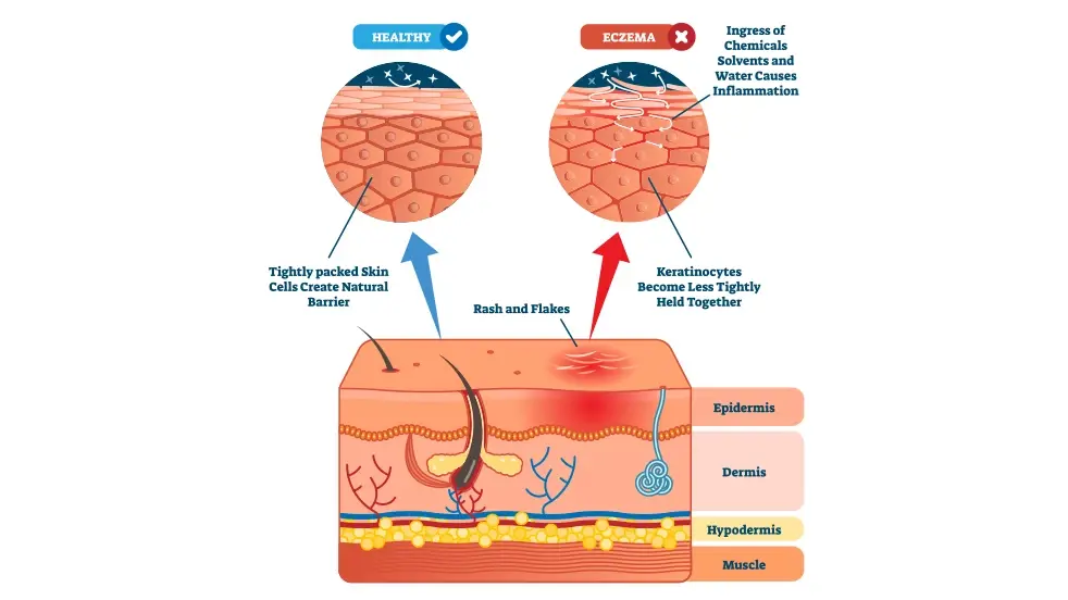 Lisez ici ce qu'est l'eczéma et quelles peuvent être les causes.