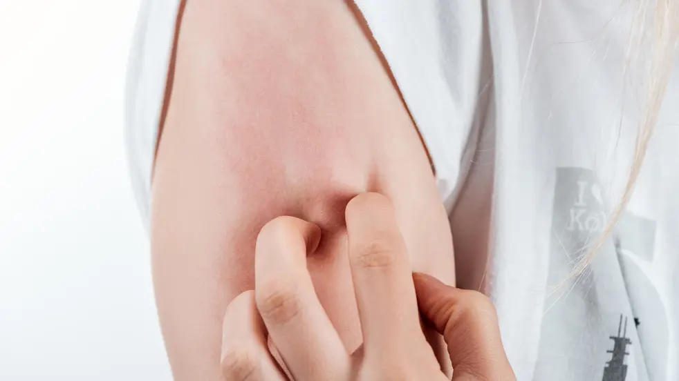 Eczeem gaat vaak gepaard met de nood om te krabben. Vermijd krabben zodat de ontstekingsreactie niet langer aanhoudt.