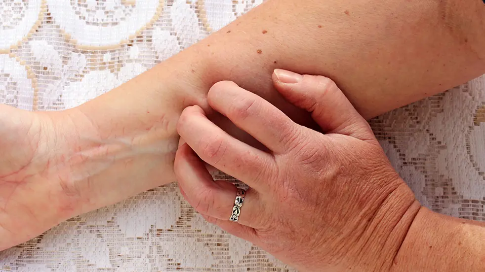 Neurodermatitis heeft vaak een nerveuze factor als oorzaak en gaat gepaard met een hevige nood om te krabben.