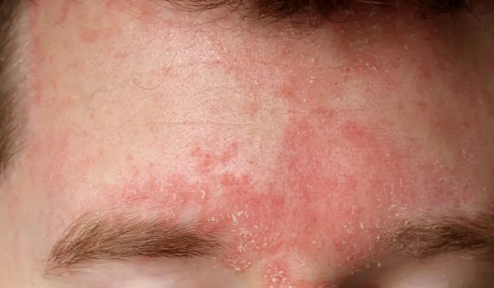 Lorsque le champignon Malassezia furfur commence à proliférer, le patient peut développer un eczéma séborrhéique.