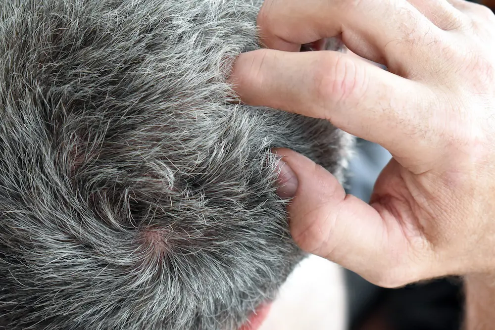 Irritation du cuir chevelu