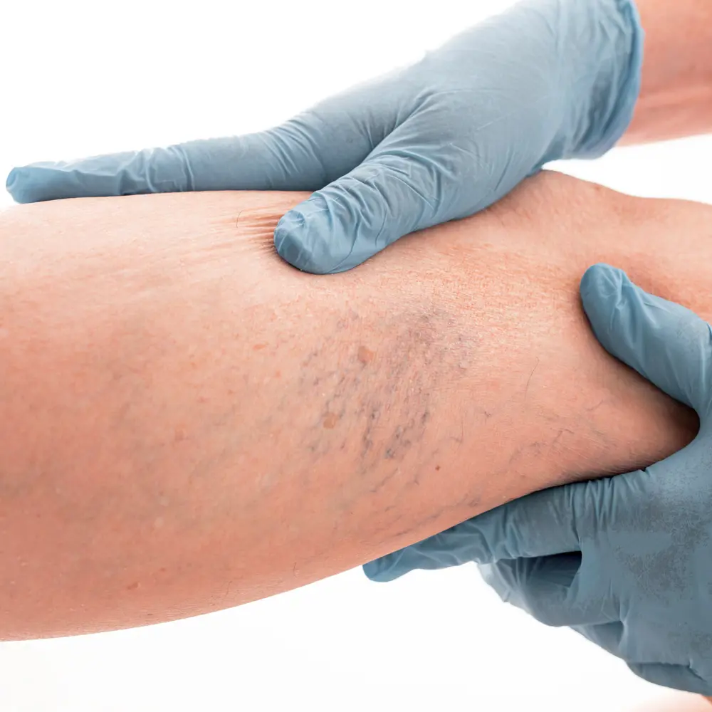 Een gezonde levensstijl, medische compressie met steunkousen en geneesmiddelen helpen bij klachten van chronische veneuze insufficiëntie