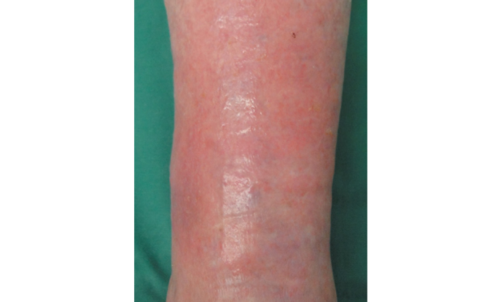 Symptomen van oppervlakkige tromboflebitis