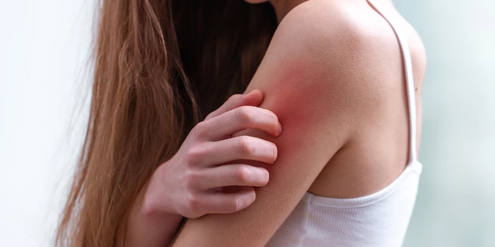 Quels sont les principaux symptômes de l'urticaire ?