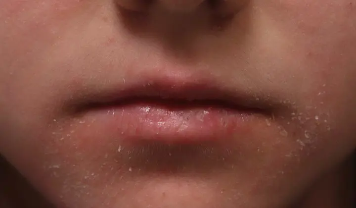 Des pellicules en grande quantité peuvent indiquer la présence de séborrhée ou d'eczéma séborrhéique.