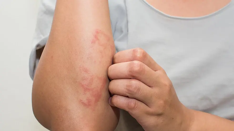 Découvrez ici quels sont les symptômes de l'eczéma.