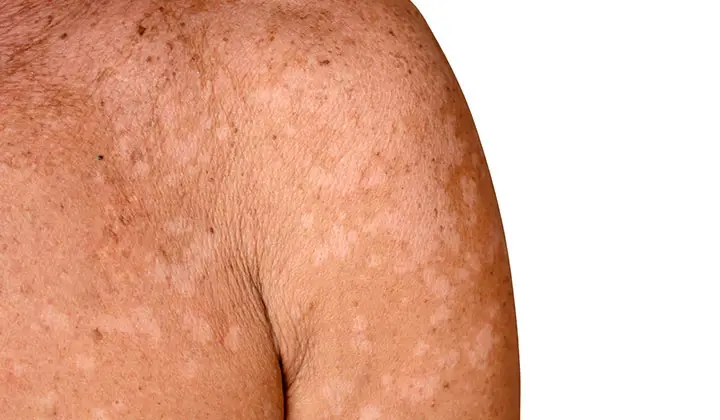 Ketoconazol pakt ook de huidaandoening pityriasis versicolor doeltreffend aan.