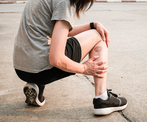 Hématomes ou contusions