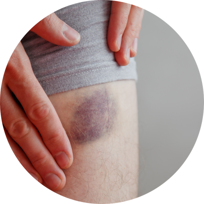 Bloeduitstorting op de plek waar het bloed zich verzamelt