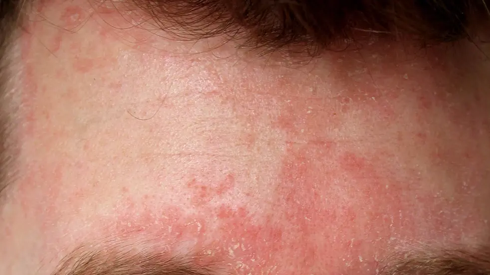 Vous pouvez lire ici quels types d'eczéma existent.