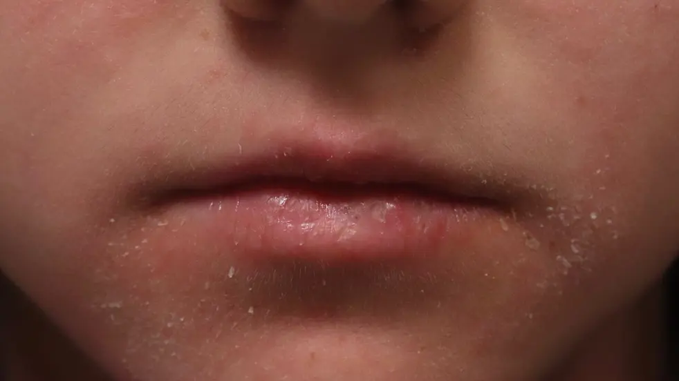 Schilfers in grote hoeveelheden kunnen wijzen op roos of seborroïsch eczeem.