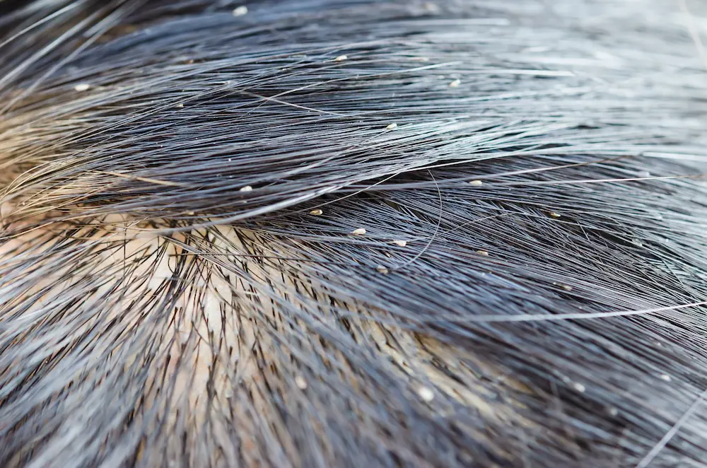 Peut-on savoir si on a des poux sans peigne fin ? 