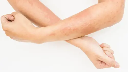 Als gevolg van contact met een bepaald allergeen kan een allergische huidreactie ontstaan.